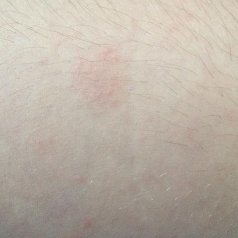 Ausschlag - (Grippe, Ausschlag, ebola)