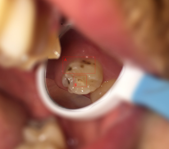 Betroffener Zahn - (Gesundheit, Zähne, Zahnarzt)