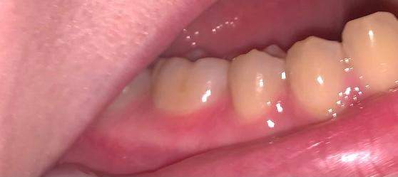 Habe Ich Ein Loch Im Zahnm Zahne Habe Ich Ein Loch Im Zahnm Zahne