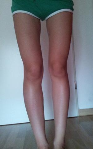 x- beine ? - (Beine, Anatomie)