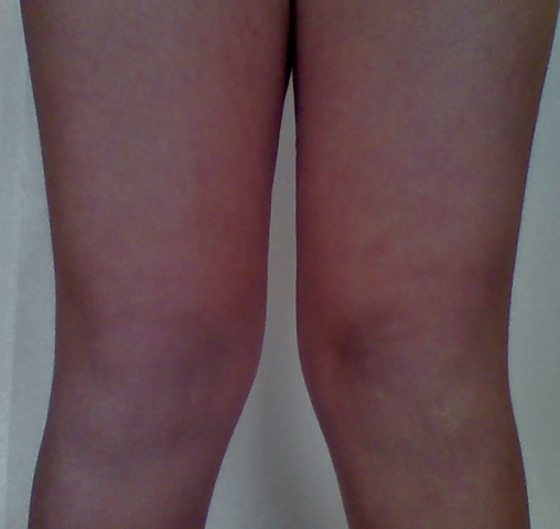 Das sind meine Beine - (Gesundheit, Orthopädie, Beinfehlstellung)