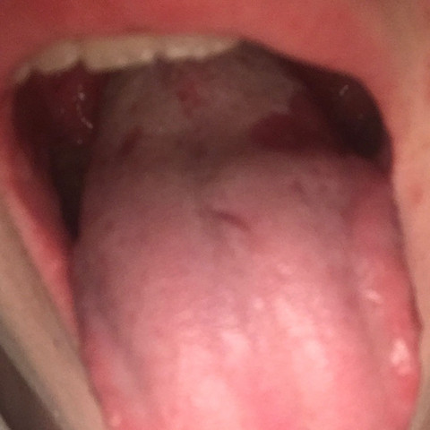 Zungee - (Gesundheit, Zunge, Schuppenflechte)