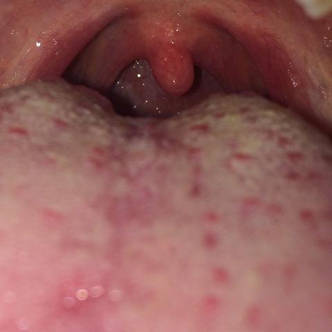 Mandelentzündung Zunge