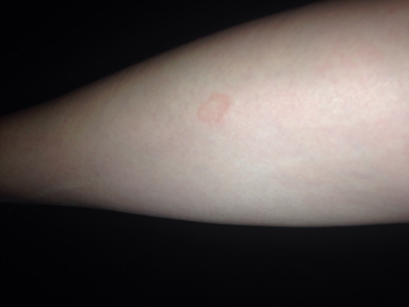 Habe Ich Eine Schuppenflechte Schienbein Habe Ich Eine Schuppenflechte Schienbein