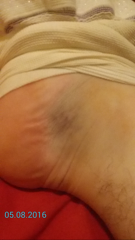 angst vor thrombose