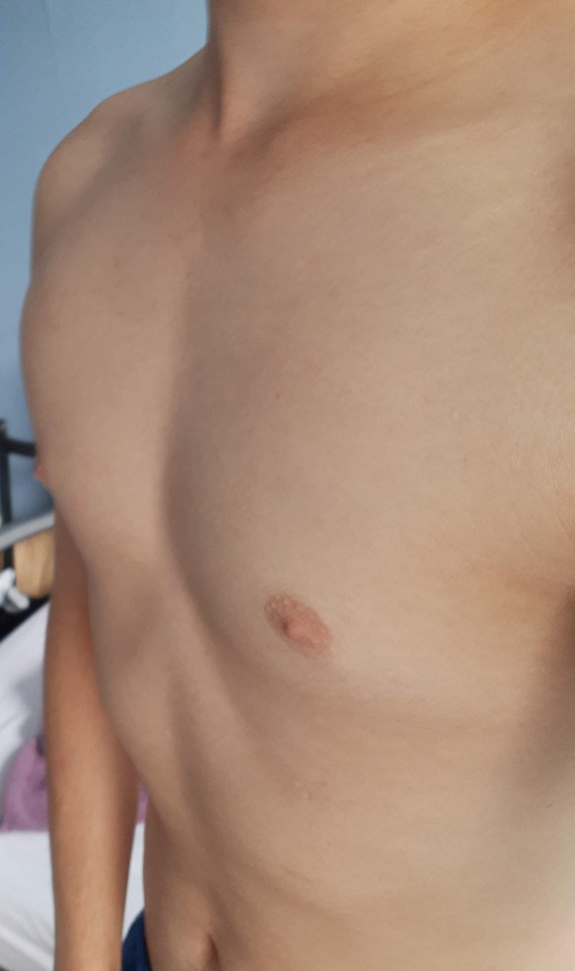 Trichterbrust frauen