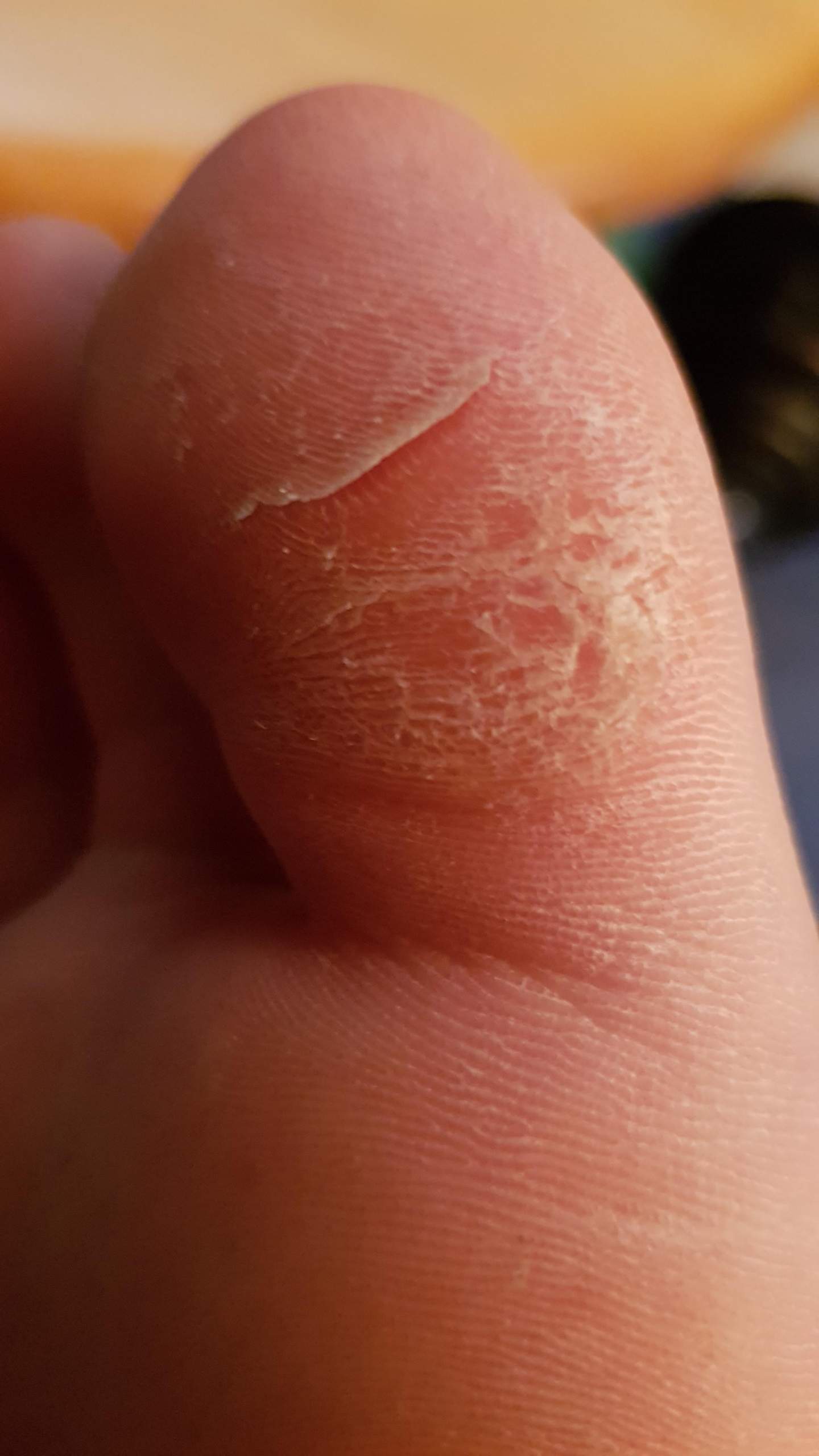 Habe ich einen Fußpilz? Und woher kommt dieser Riss? (Gesundheit ...