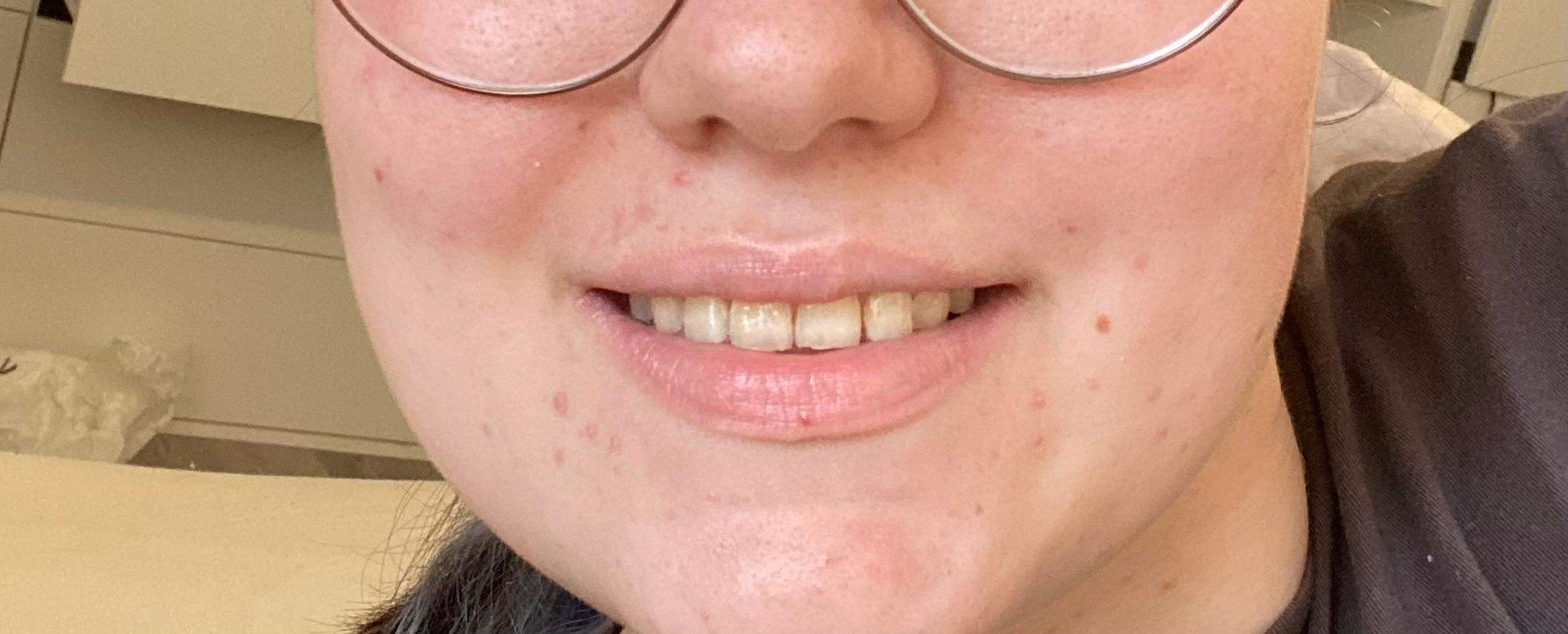 Habe ich gelbe Zähne oder sind die ok? (Zahnarzt, Verfärbung)