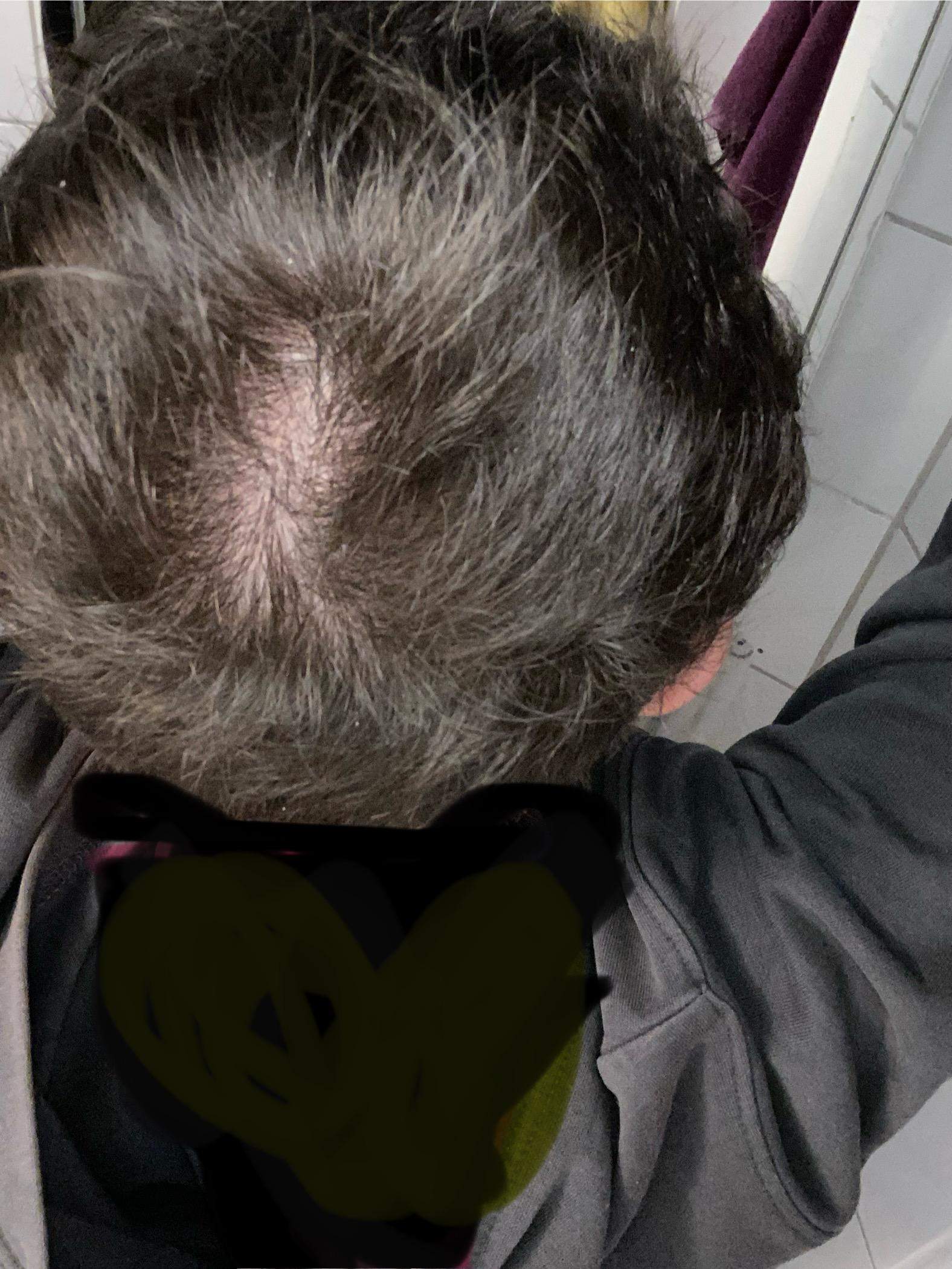 Habe ich Haarausfall? (Angst, Tipps, Hilfestellung)