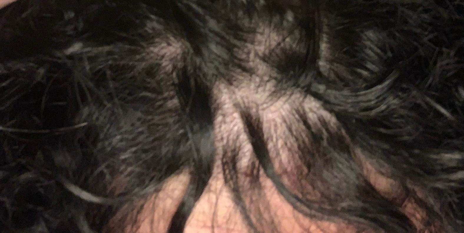 Habe ich Haarausfall bin erst 15? (Pubertät, Haarpflege, Kopfhaut)