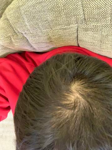 habe ich haarausfall ich bin 14 haare