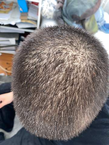 habe ich haarausfall oder ahnliches