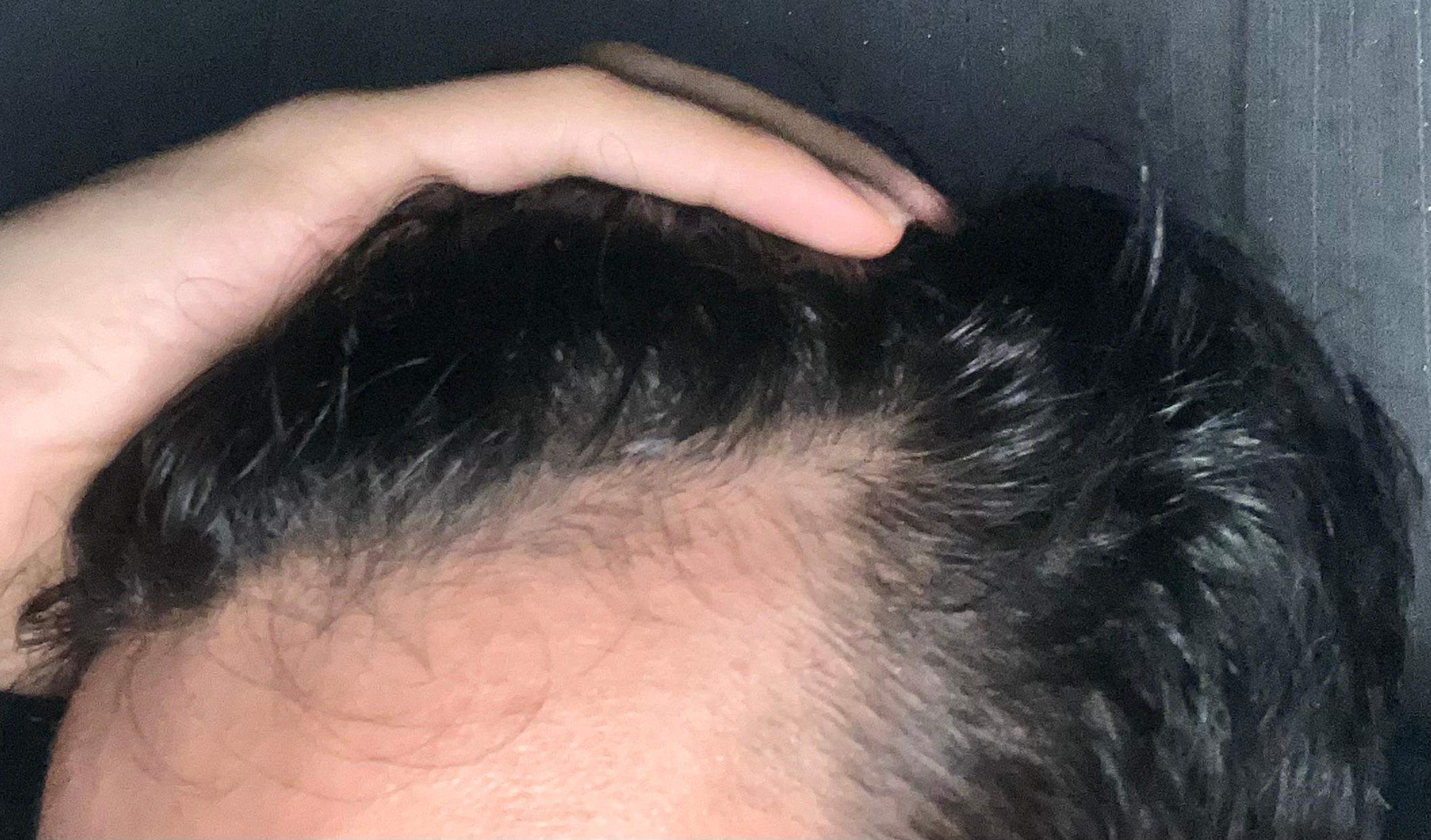 Habe ich Haarausfall sehe Bild? (Pubertät, Haarausfall stoppen, Haarverlust)