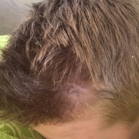 Habe Ich Haarausfall Pso Gesundheit Und Medizin Schuppenflechte