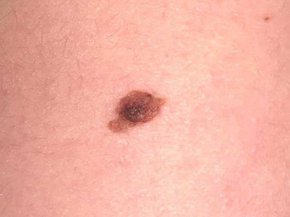 habe ich hautkrebs oder ist es normal gesundheit und medizin krebs