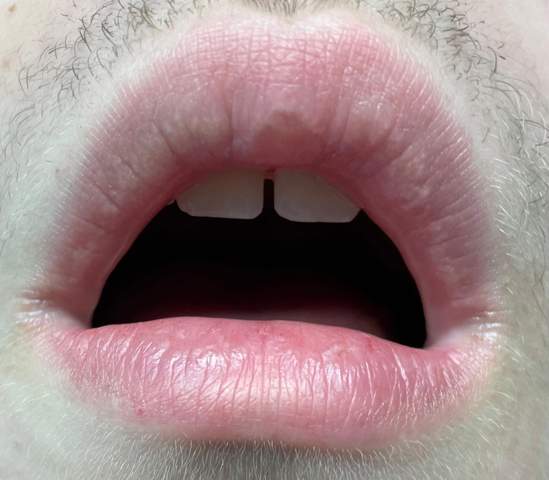 Habe ich Herpes oder was anderes oder sind meine Lippen normal?