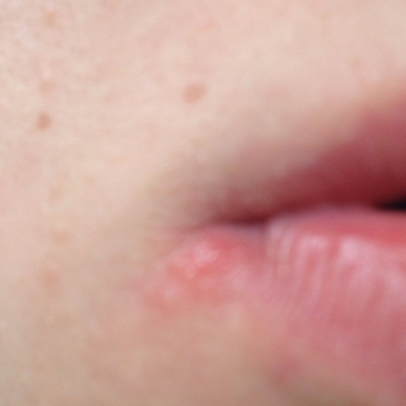 Habe ich Herpes? Oder was ist dass? (Gesundheit, Krankheit, Virus)