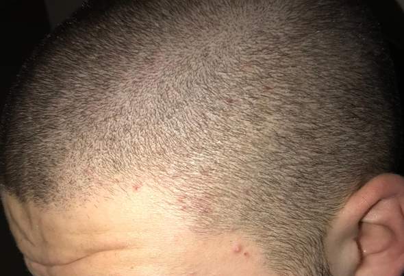 Geheimratsecken nachher minoxidil vorher Regaine bei