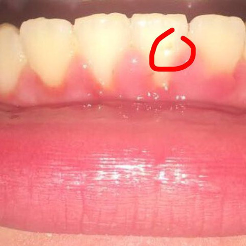 Habe Ich Karies Brauche Hilfe Schmerzen Zahne Zahnarzt Habe Ich Karies Brauche Hilfe Schmerzen Zahne Zahnarzt