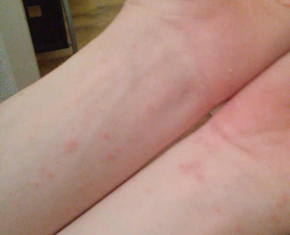 Rote Flecken am Arm - (Haut, Allergie, kretze)