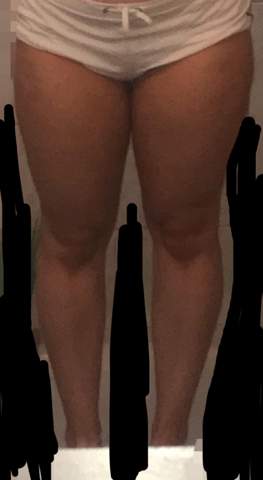 Habe Ich Lipodem Oder Bin Ich Einfach Nur Fett Gesundheit Ernahrung Frauen Habe Ich Lipodem Oder Bin Ich Einfach Nur Fett Gesundheit Ernahrung Frauen