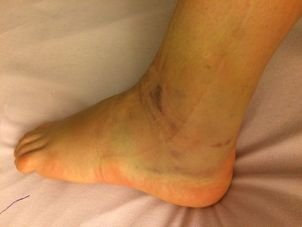 Habe Ich Mir Den Fuss Verstaucht Oder Doch Etwas Gerissen Arzt Band Knochen