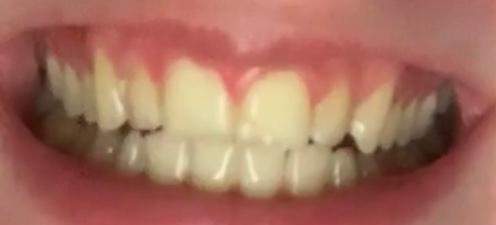Habe Ich Mit 16 Zu Gelbe Zahne Zahnpflege