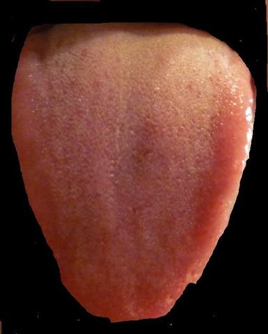 Meine Zunge (1) - (Mund, Erkrankung, Belag)