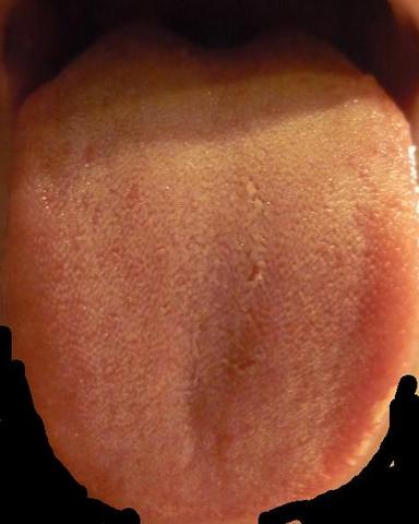 Meine Zunge (2) - (Mund, Erkrankung, Belag)