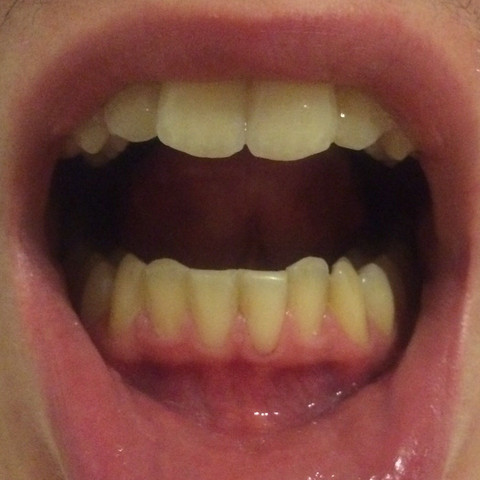 Hier sieht ihr ein Biöd von meinen Zähnen - (Krankheit, Zähne, Zahnarzt)