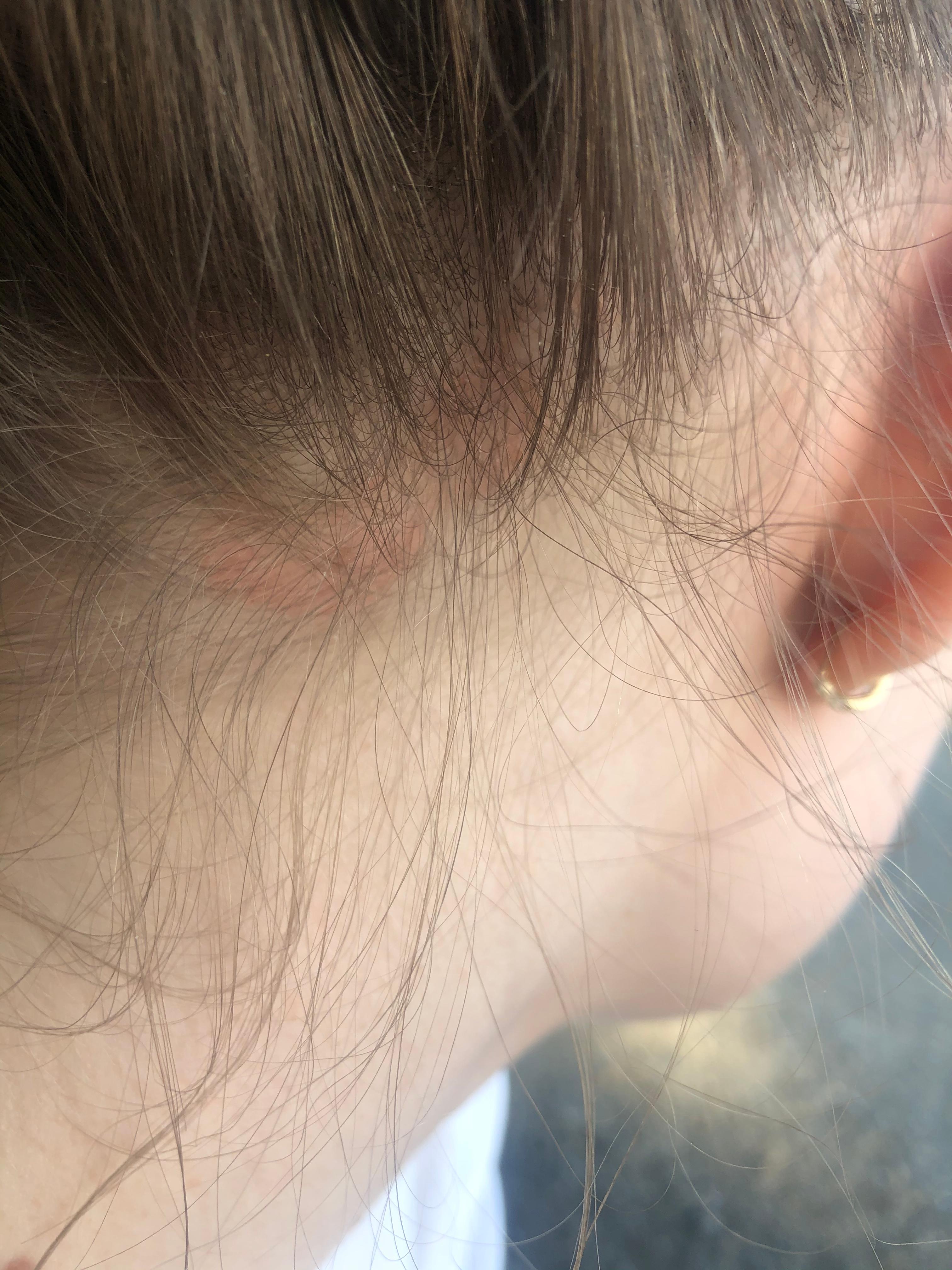 habe ich psoriasis gesundheit und