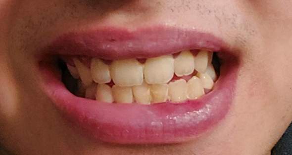 Zähne schlechte ZÄHNE UND