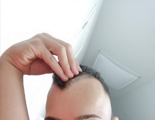 Habe Ich Starke Geheimratsecken Oder Nicht Gesundheit Und Medizin Haare Beauty