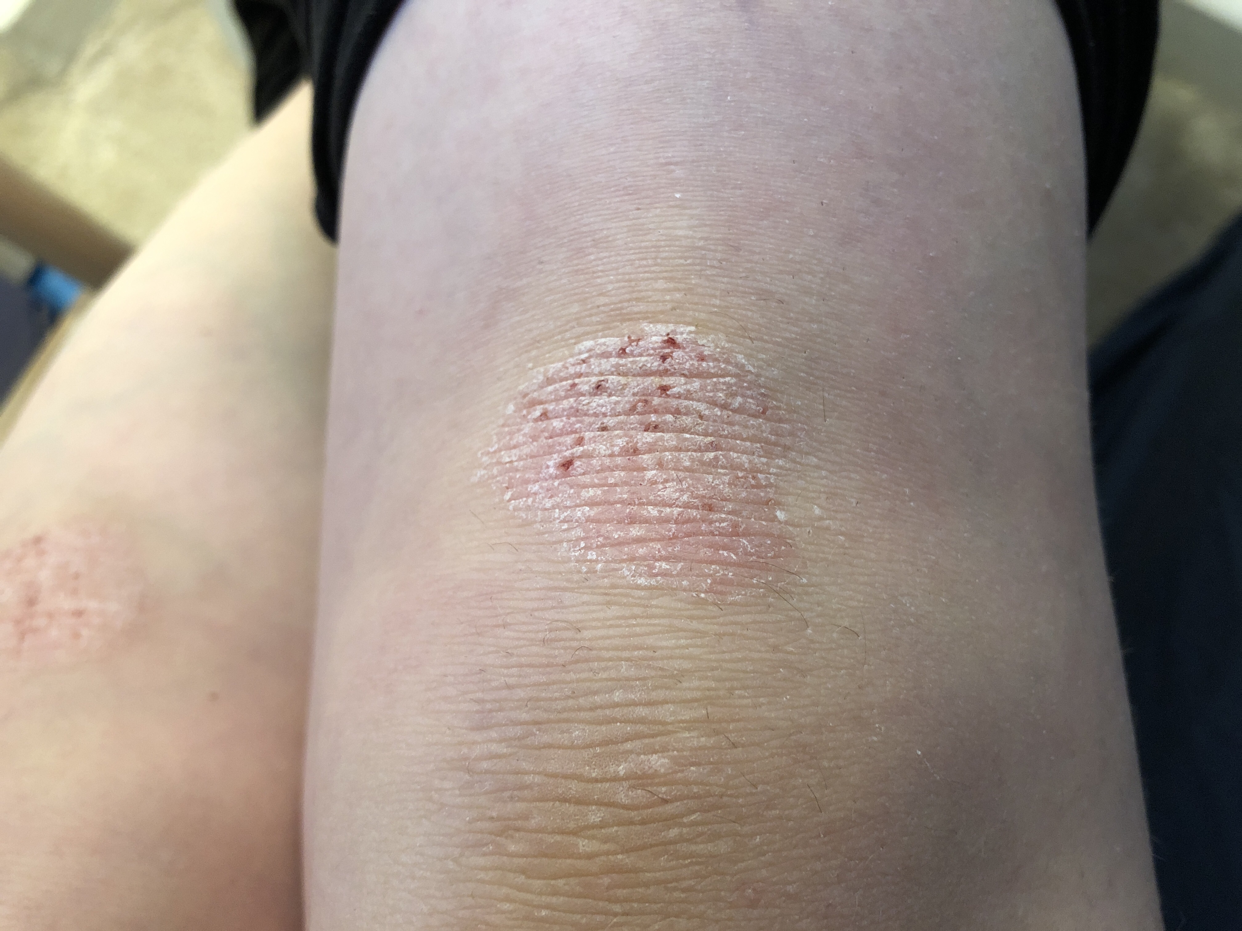 Habe ich vielleicht Neurodermitis? (Haut)