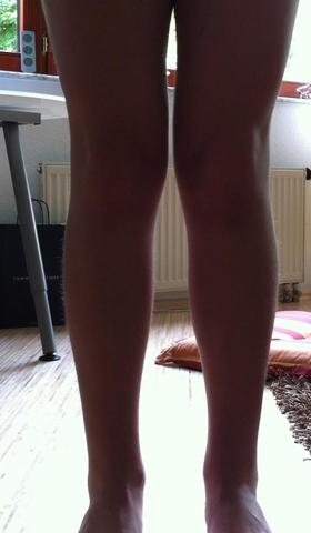 Meine Beine - (Arzt, X-Beine)