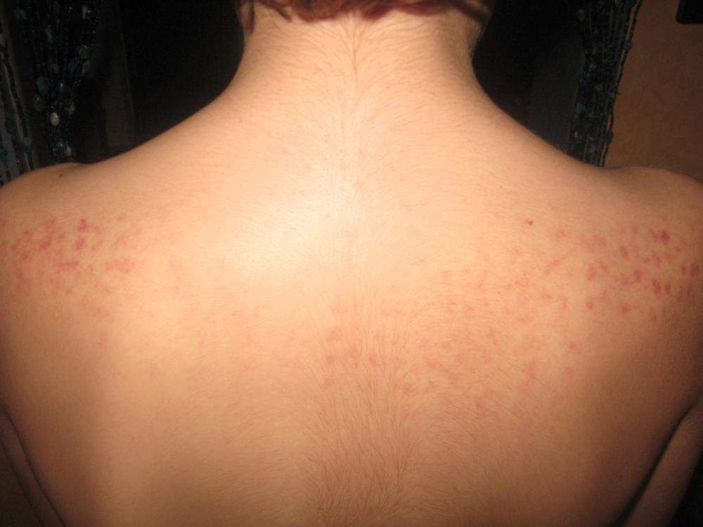 Habe komische Punkte am rücken (bild vorhand) (Gesundheit, Beauty, Kosmetik)