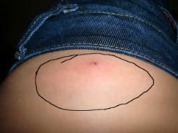 Bild 1 - (Allergie, Insektenstich, Hauterkrankung)