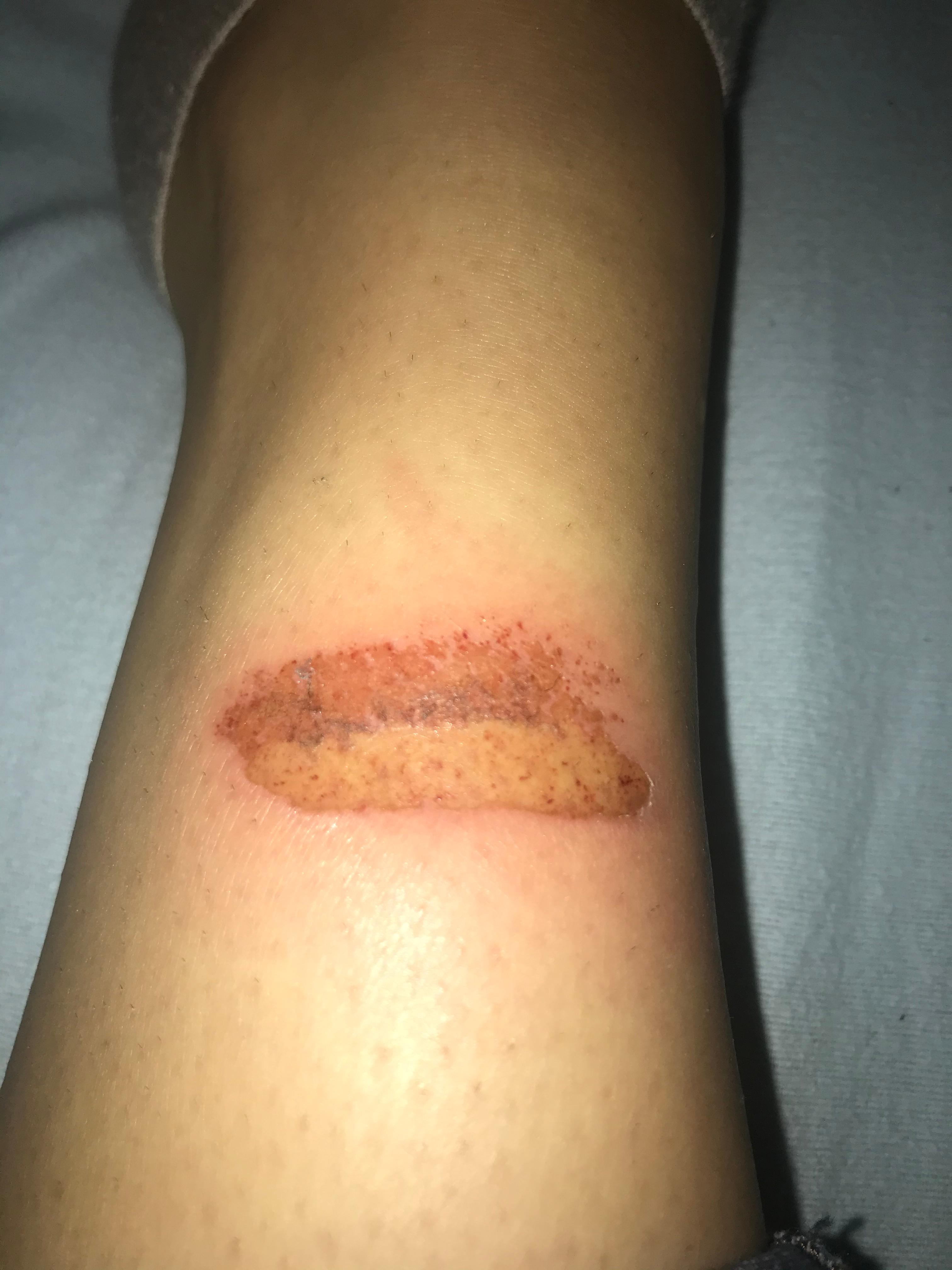 Habe mich an der leine meines hundes verbrannt hat jemand tipps? (Hund