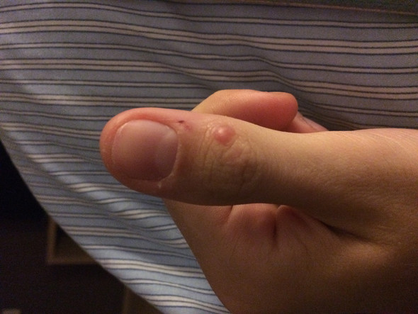 Knubbel finger knor vs