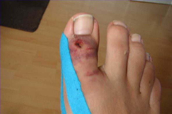 Habe Mir Den Grossen Zehe Gebrochen Wie Lange Werde Ich Denn Ca Krank Geschrieben Werden War Schon Im Krankenhaus Sie Sagten So Ein Paar Wochen Schonen Krankheit Habe Mir Den Grossen Zehe Gebrochen Wie Lange Werde Ich Denn Ca Krank Geschrieben Werden War Schon Im Krankenhaus Sie Sagten So Ein Paar Wochen Schonen Krankheit
