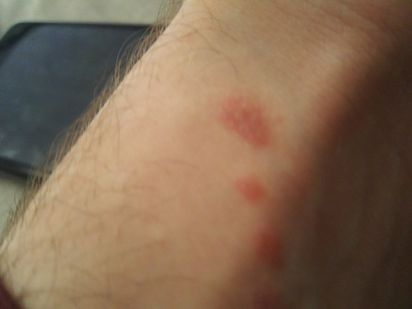 Habe Rotungen Auf Der Haut Krankheit Hautkrankheit