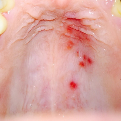 Habe Rote Flecken Im Mund Gaumen Breich Was Kann Das Sein Habe Rote Flecken Im Mund Gaumen Breich Was Kann Das Sein