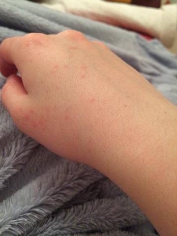 Habe Rote Punkte In Meinem Hand Bekommen Was Ist Das Bild Gesundheit Haut Rot Habe Rote Punkte In Meinem Hand Bekommen Was Ist Das Bild Gesundheit Haut Rot