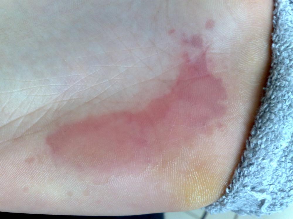 Habe roten Fleck am Fuß? (Gesundheit, Medizin) Habe roten Fleck am Fuß? (Gesundheit, Medizin)