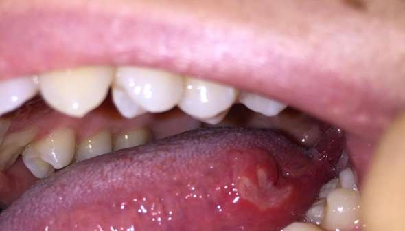 Auf der zunge bläschen hinteren Mundfäule: Symptome