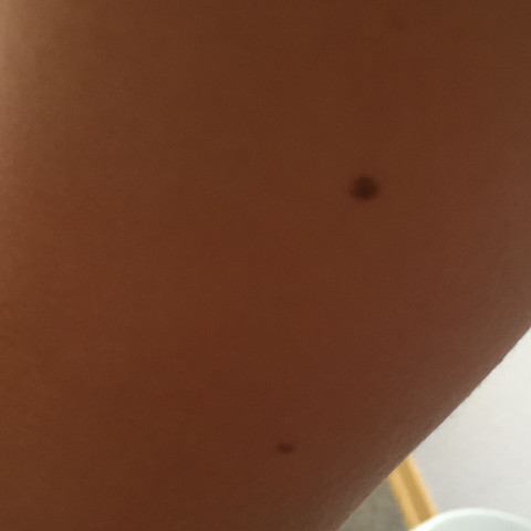 Habe Schwarze Punkte Bekommen Hautkrebs Schwarze Punkte Habe Schwarze Punkte Bekommen Hautkrebs Schwarze Punkte