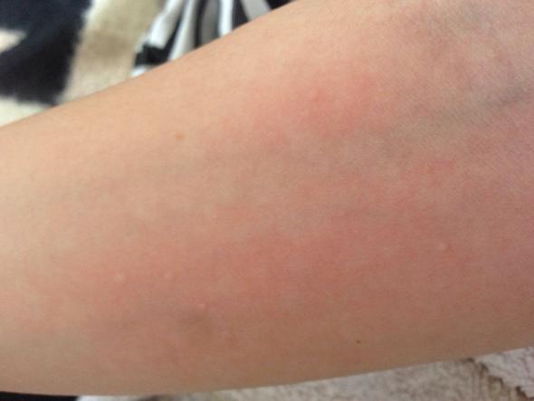 Habe Seit 2 Tagen Juckende Haut Bein Arme Hals Bauch Dadurch Kriege Ich Ausslag Und Kleine Hautfarbige Punkte Was Kann Das Sein Korper Krankheit Krank Habe Seit 2 Tagen Juckende Haut Bein Arme Hals Bauch Dadurch Kriege Ich Ausslag Und Kleine Hautfarbige Punkte Was Kann Das Sein Korper Krankheit Krank