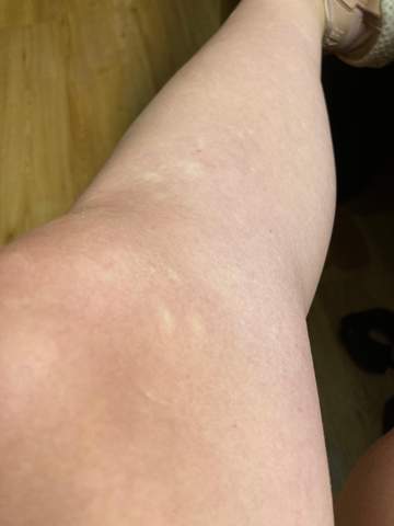 Habe Seit Circa Einem Jahr Kleine Weisse Flecken An Den Beinen Soll Ich Damit Zum Arzt Gesundheit Und Medizin Hautprobleme