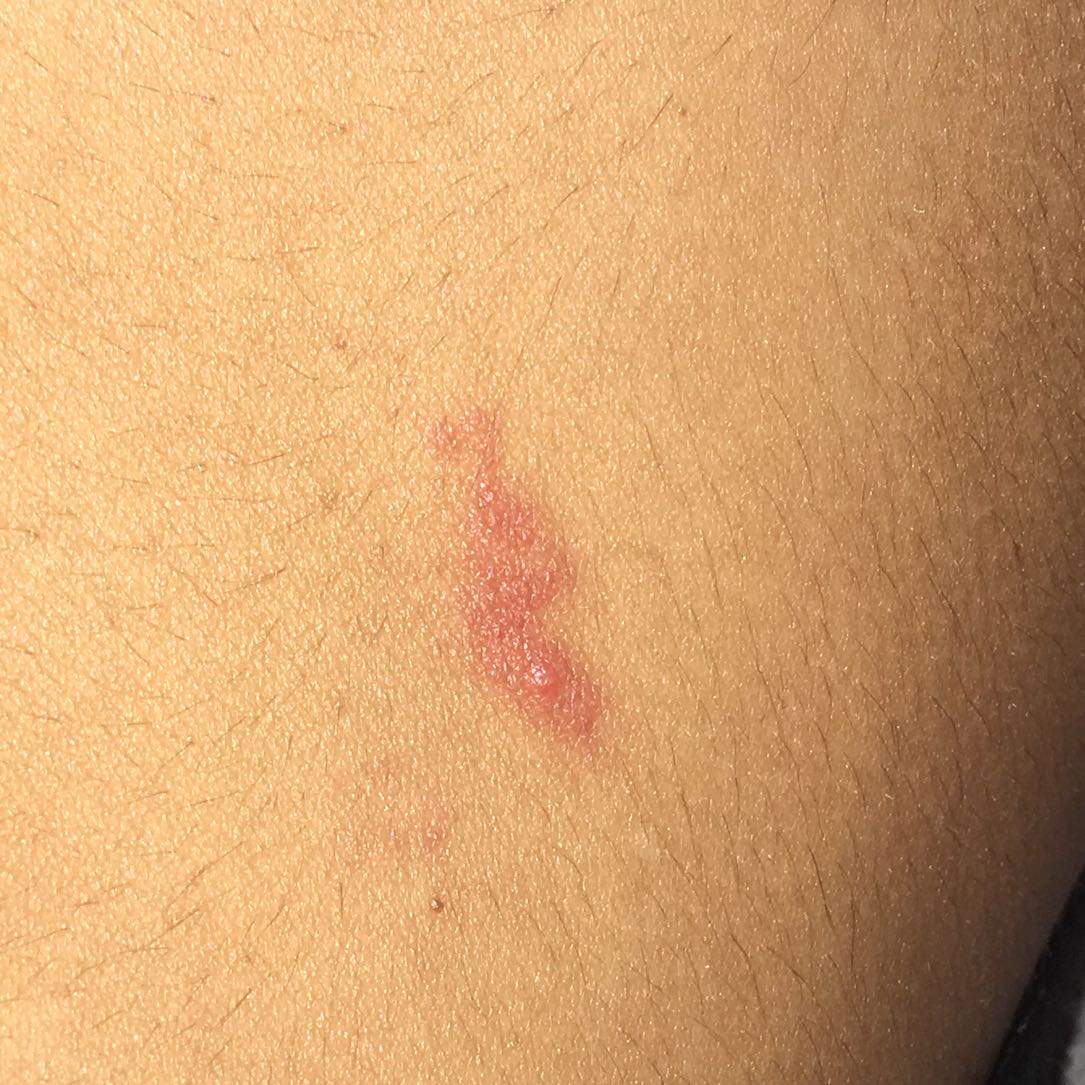 Roter Streifen Auf Der Brust Ausschlag Unter Der Brust Ursachen Und Roter Streifen Auf Der Brust Ausschlag Unter Der Brust Ursachen Und
