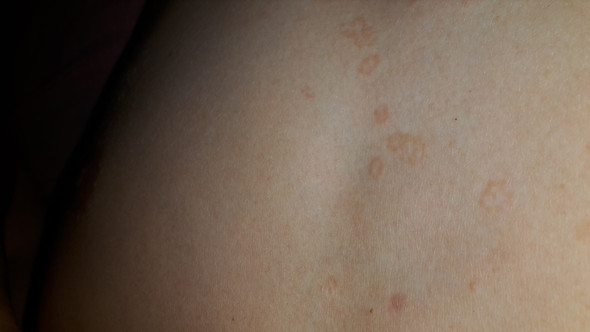 Habe seit einiger Zeit so braune Flecken zwischen der Brust. Kein Habe seit einiger Zeit so braune Flecken zwischen der Brust. Kein